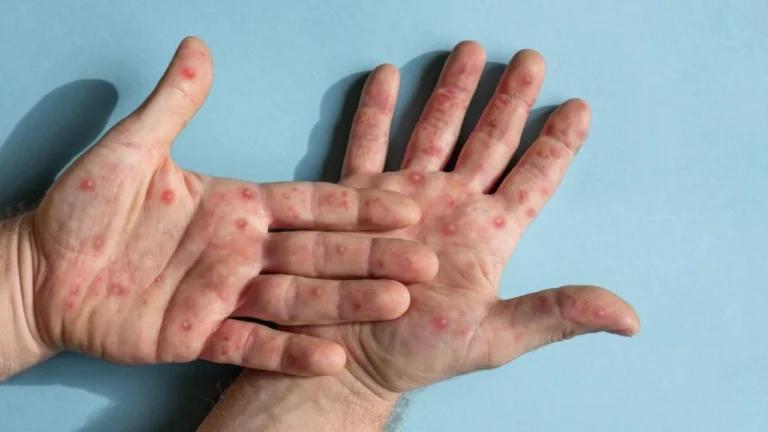Imagen: Ciudad de México reporta cuatro nuevos casos de mpox tras puente vacacional