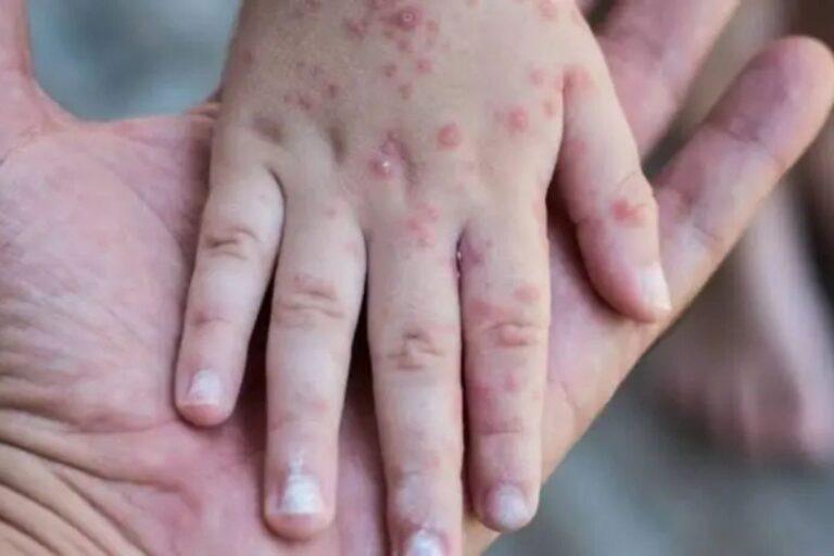 Imagen: Coxsackie en Hidalgo: Este es el llamado de la SSH ante la presencia del virus