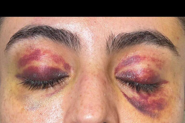 Imagen: Sobreviviente de intento de feminicidio exige justicia en Tulancingo, su agresor podría evadir el proceso