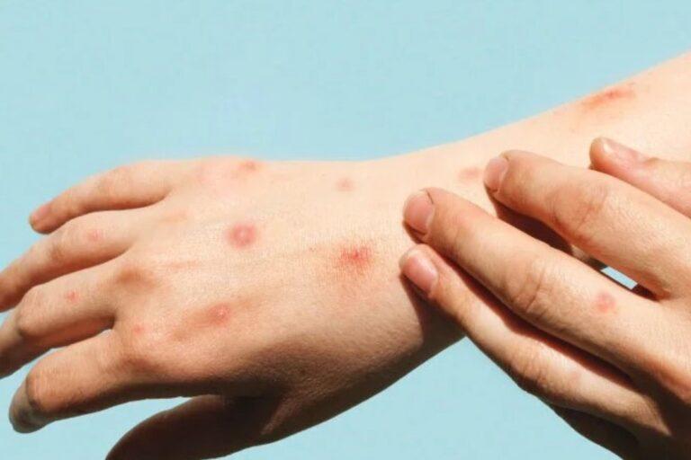 Imagen: ¿Hay contagios de mpox en las regiones Tulancingo y Otomí-Tepehua?